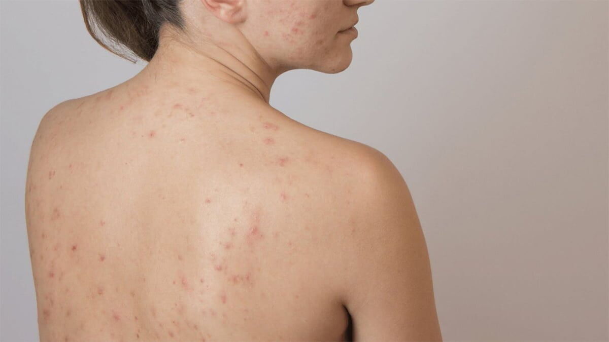 trị mụn lưng 