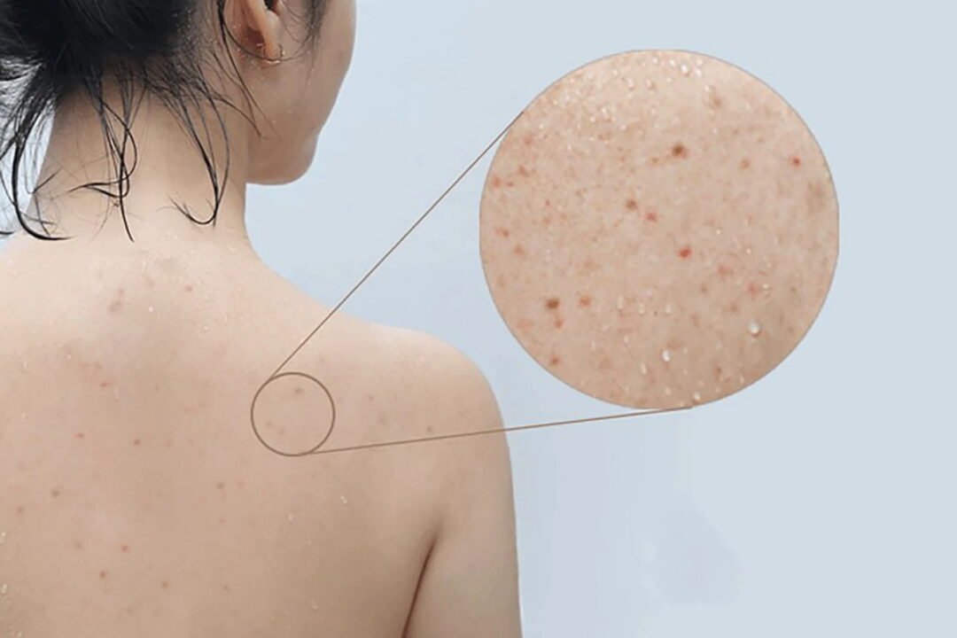 trị mụn lưng 
